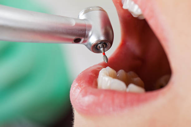 Best Emergency Broken Tooth Repair in Bellevue, OH